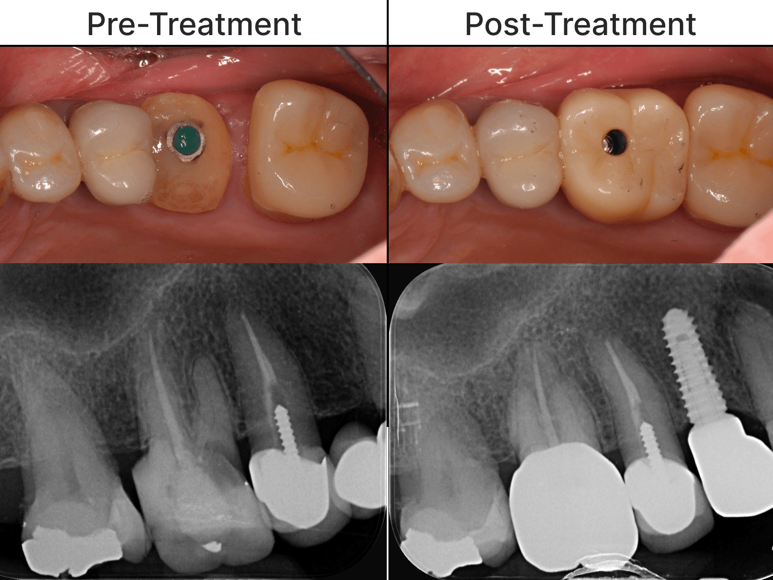 Placeholder after-treatment image for a cosmetic dentistry case