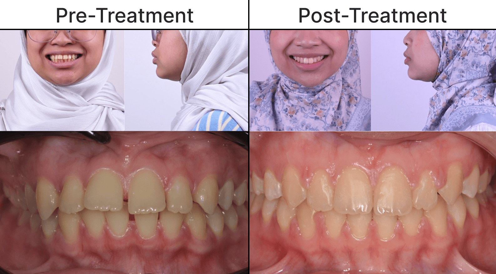 Placeholder after-treatment image for a cosmetic dentistry case