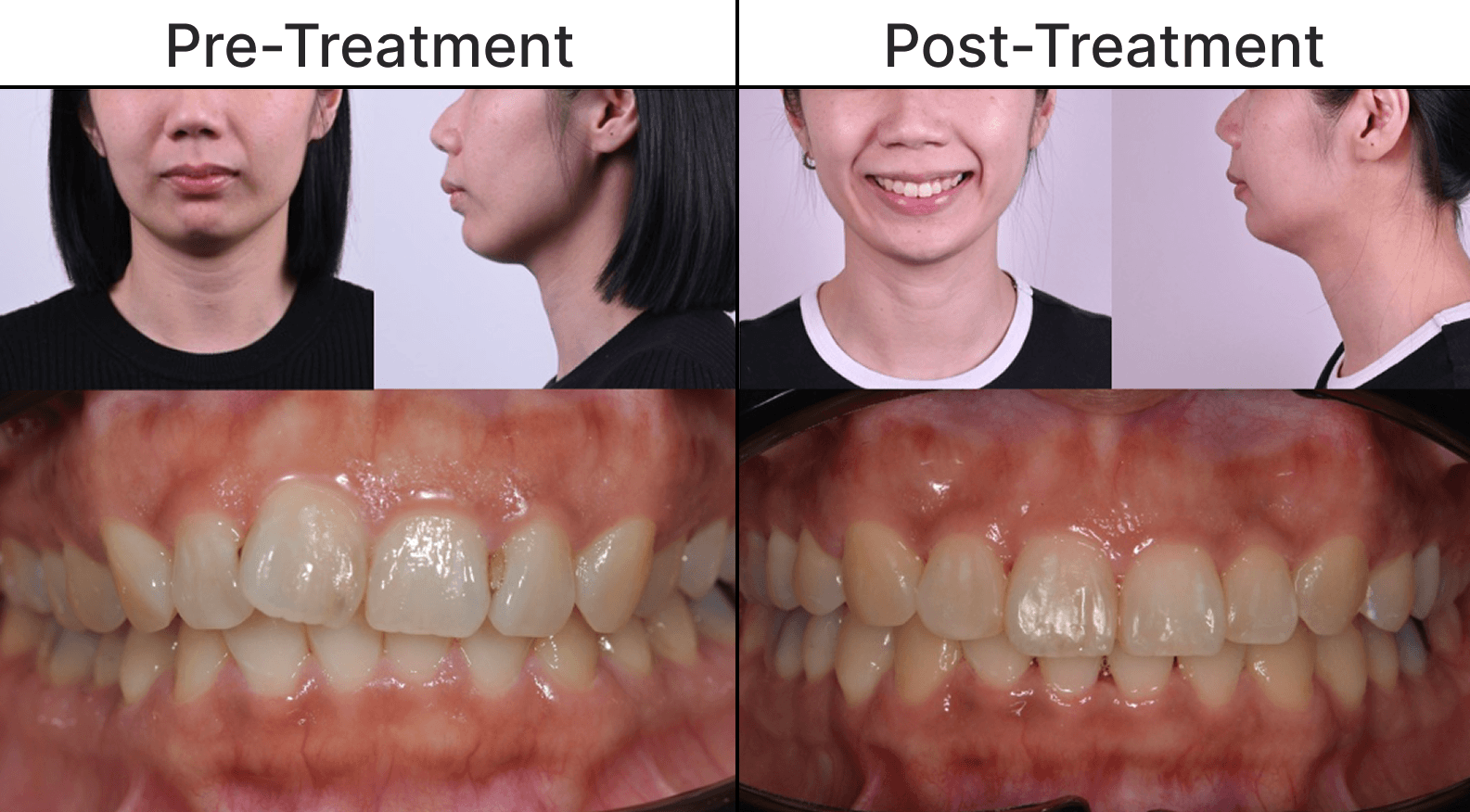 Placeholder after-treatment image for a cosmetic dentistry case