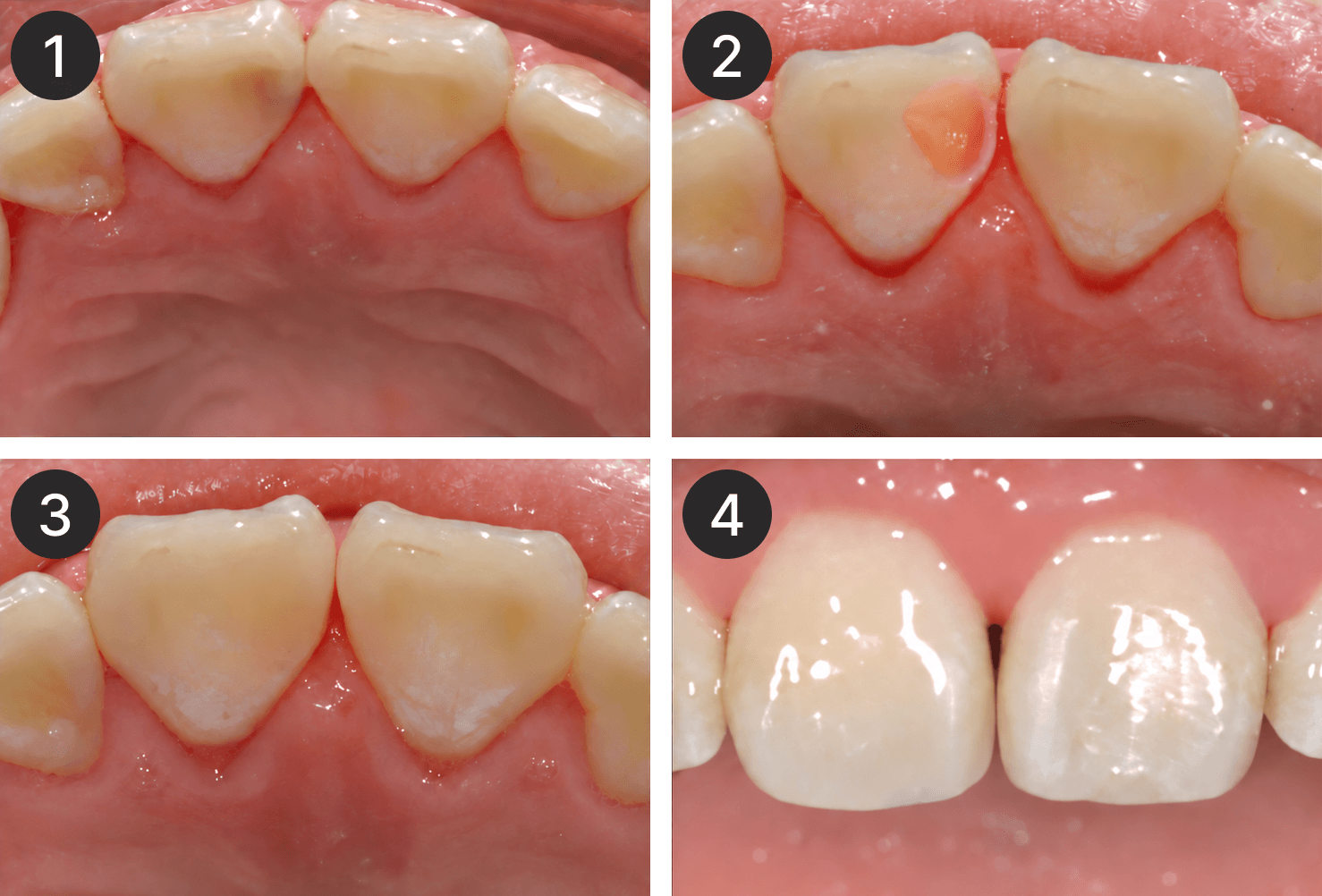 Placeholder after-treatment image for a restoration case
