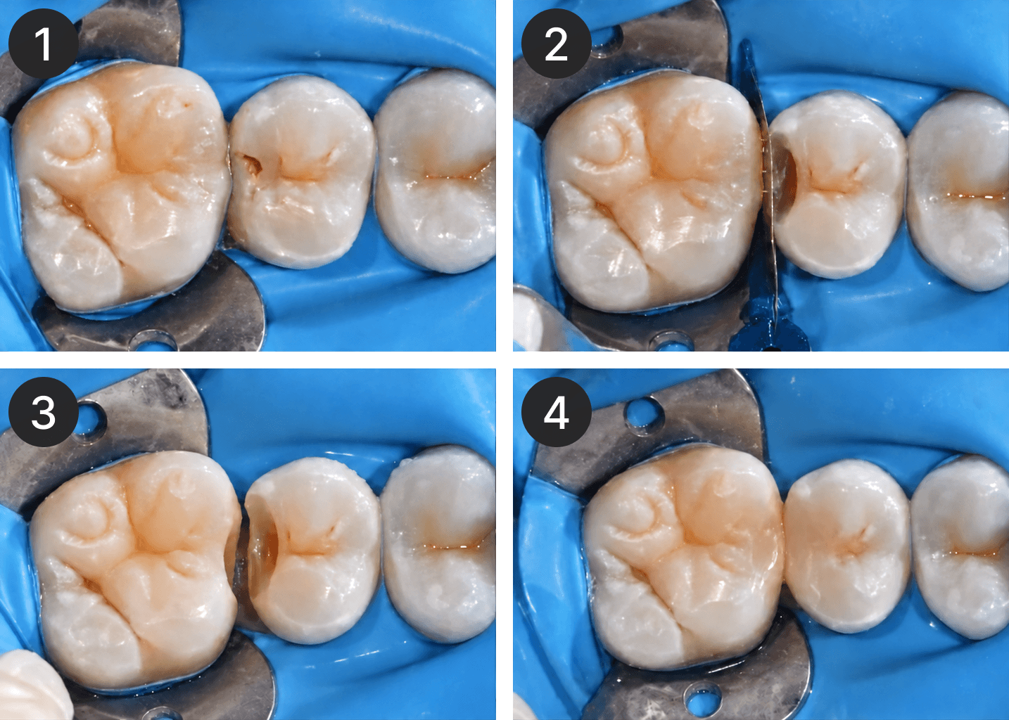 Placeholder after-treatment image for a restoration case