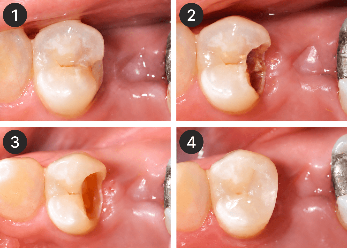 Placeholder after-treatment image for a restoration case