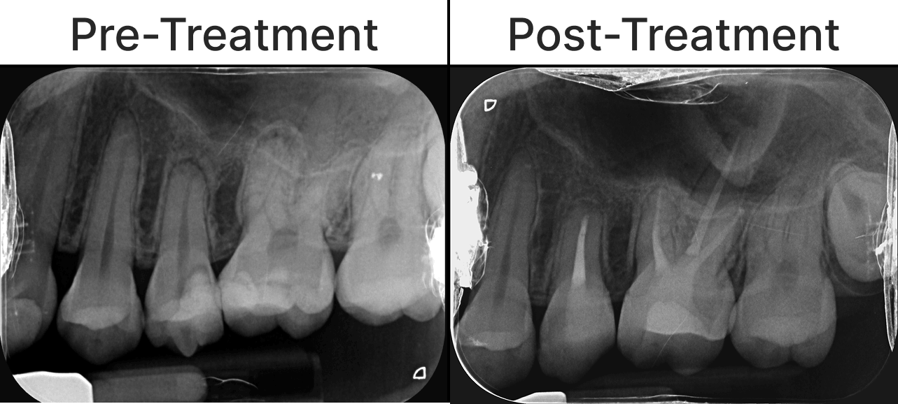 Placeholder final-treatment image for a root canal treatment case
