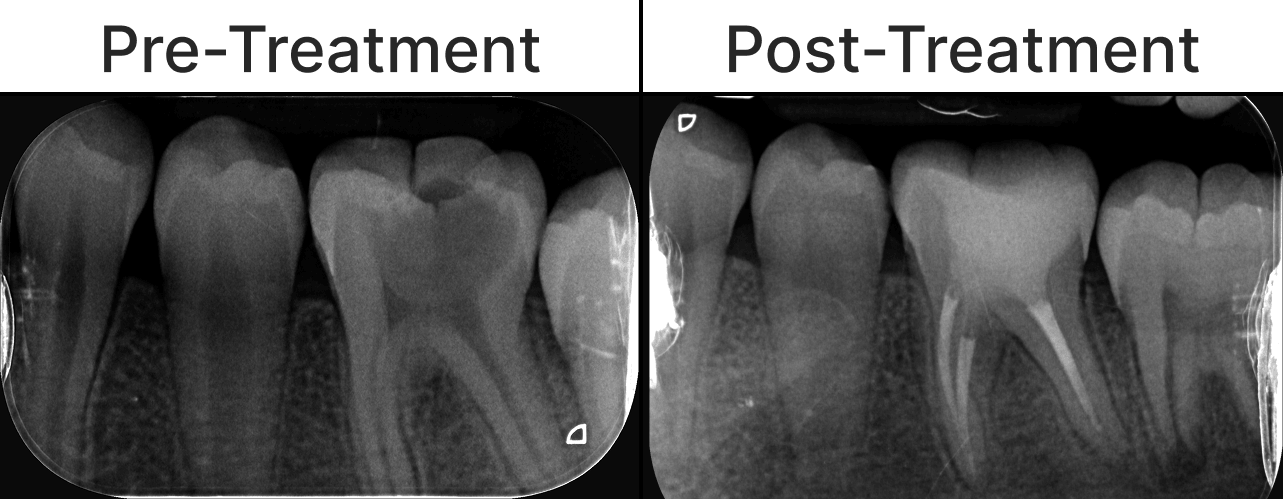 Placeholder final-treatment image for a root canal treatment case