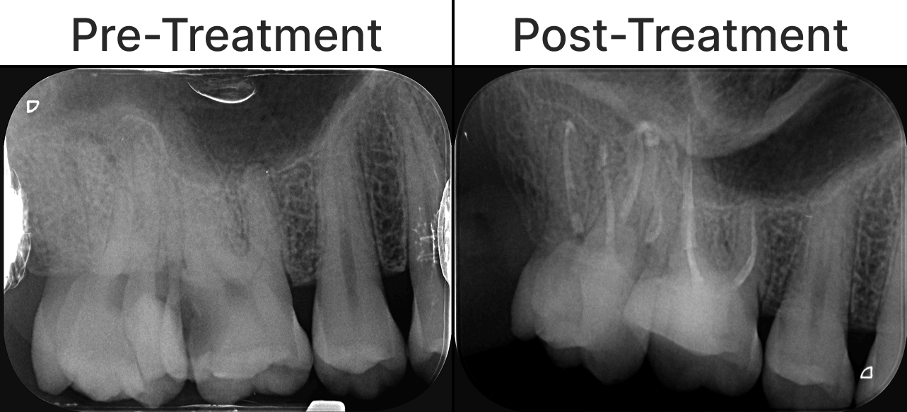 Placeholder final-treatment image for a root canal treatment case