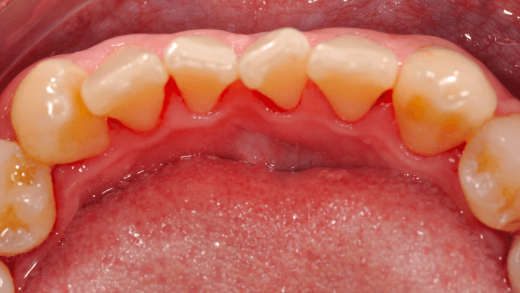 Placeholder after-treatment image for a restorative dentistry case