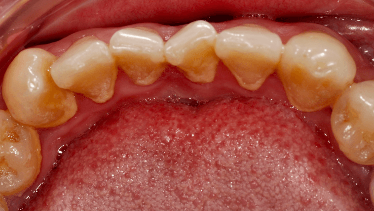 Placeholder before-treatment image for a restorative dentistry case